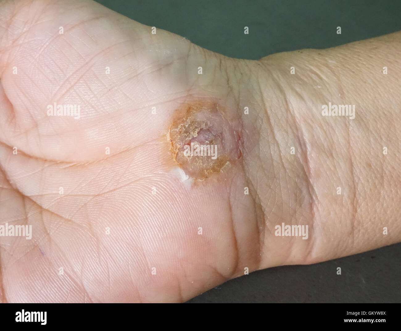 Wound Care-Prozess einerseits Frau mit medizinischen Wunde Lösung, selektiven Fokus angewendet Stockfoto