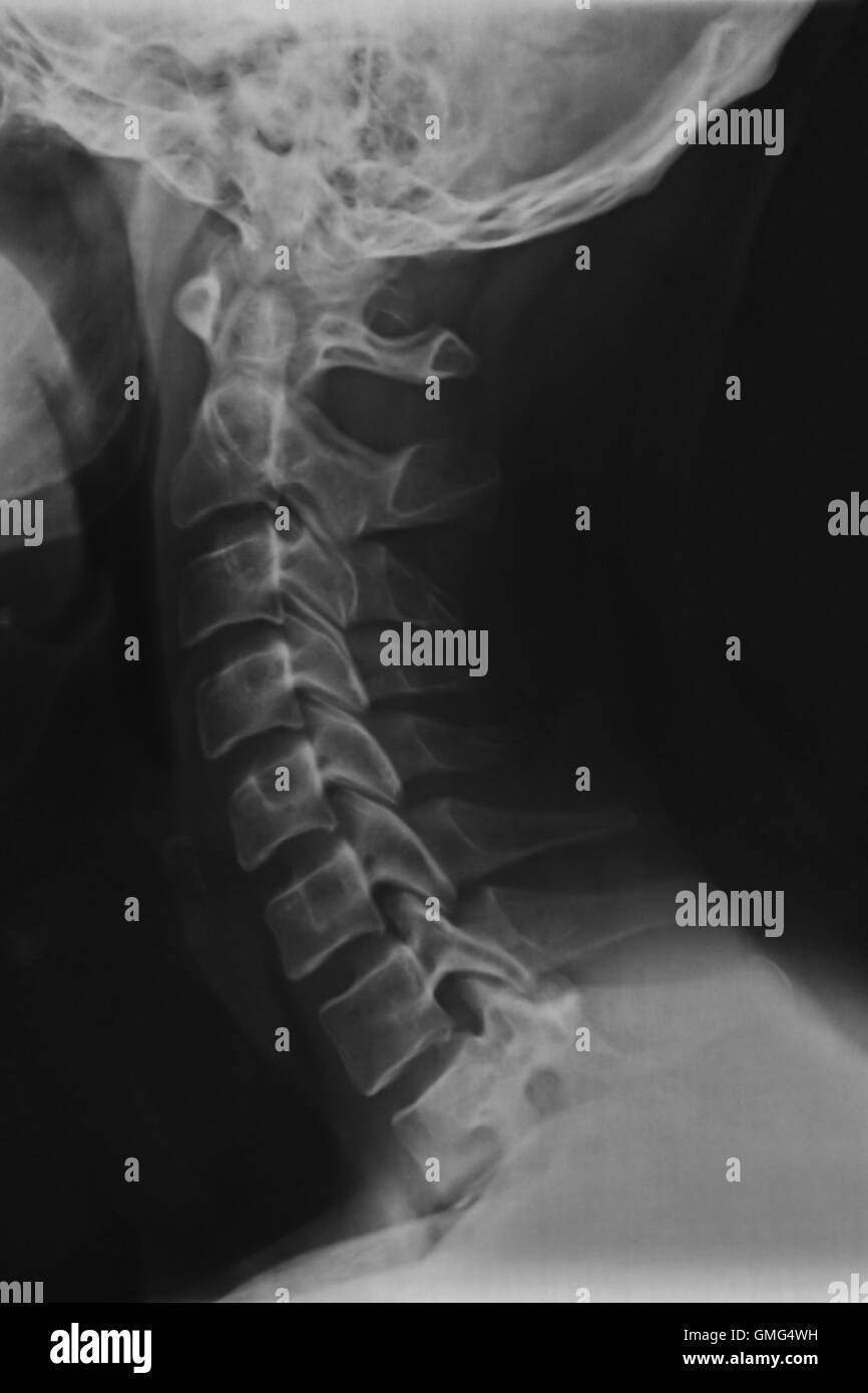 Hals und Nacken Röntgen-Scan einen 42 Jahre alten männlichen Erwachsenen. Halswirbel Anatomie. Stockfoto