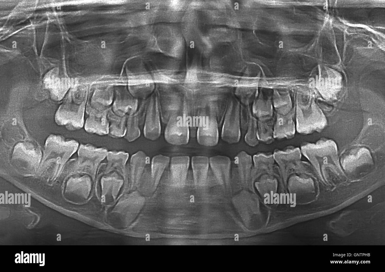 X-Ray Image von Cares Zähne Stockfoto