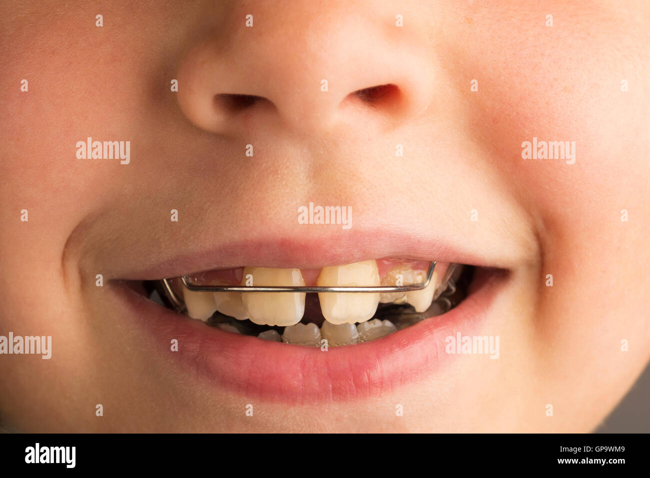 Nahaufnahme der lächelnden Mädchen tragen eine kieferorthopädische zahnmedizinische Apparatur zur Korrektur der Zähne Stockfoto
