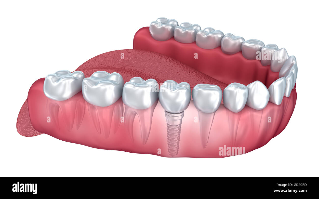 Unteren Zähne und Zahnimplantate transparent machen isoliert auf weiss. 3D illustration Stockfoto