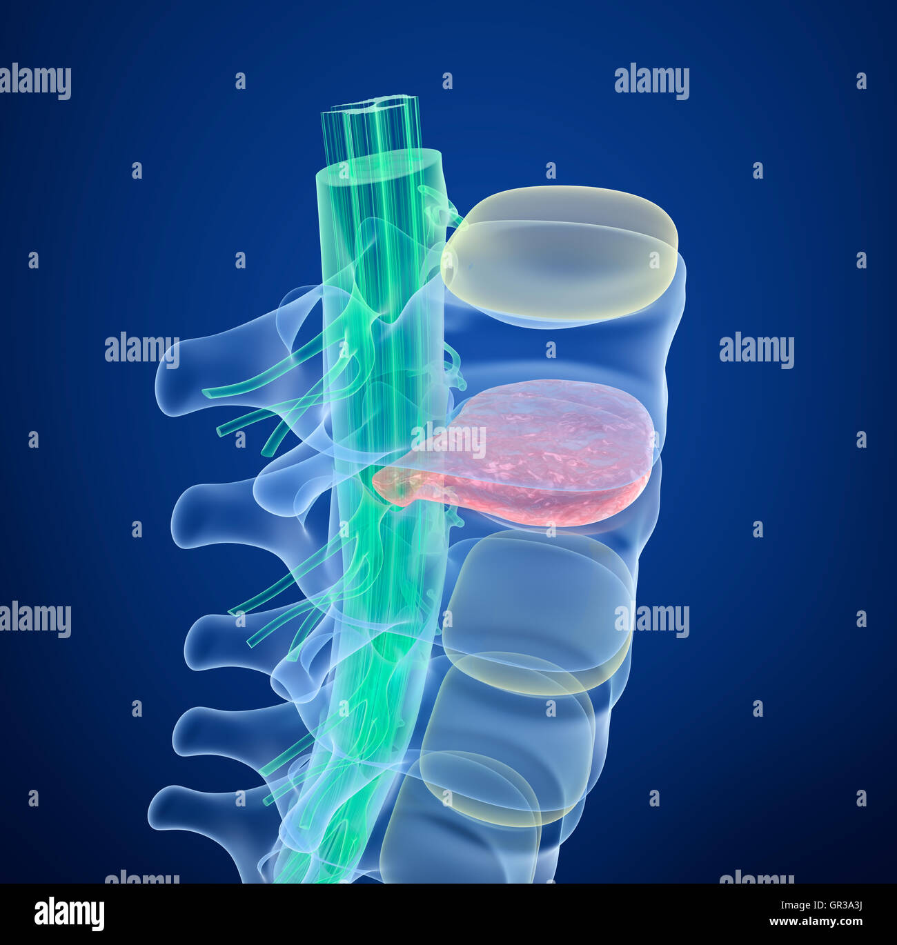 Rückenmarks unter Druck der Bandscheibenvorfall, Röntgenblick.  3D illustration Stockfoto