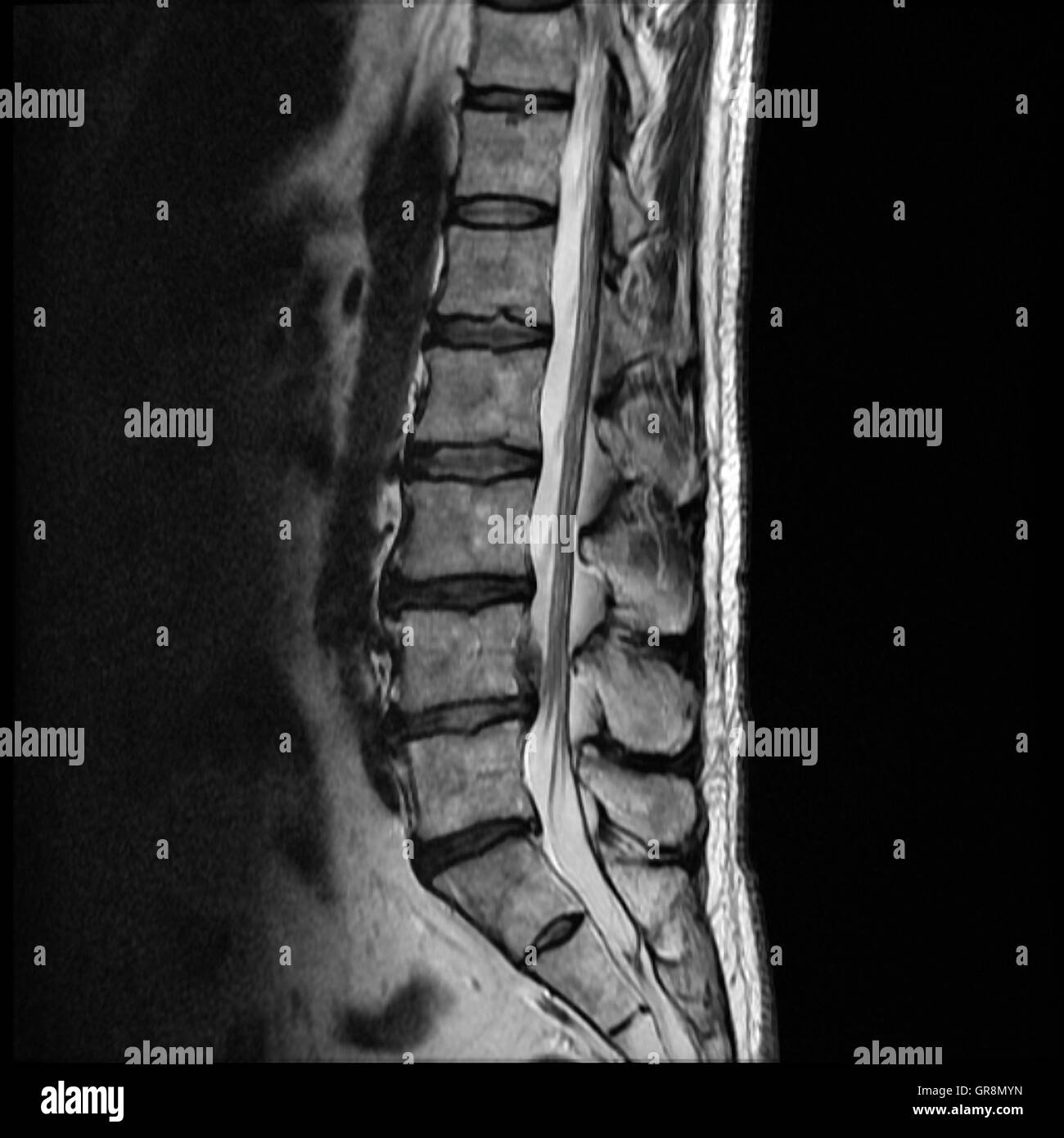 MRT von einer lumbalen Scheibe Herniation Stockfoto