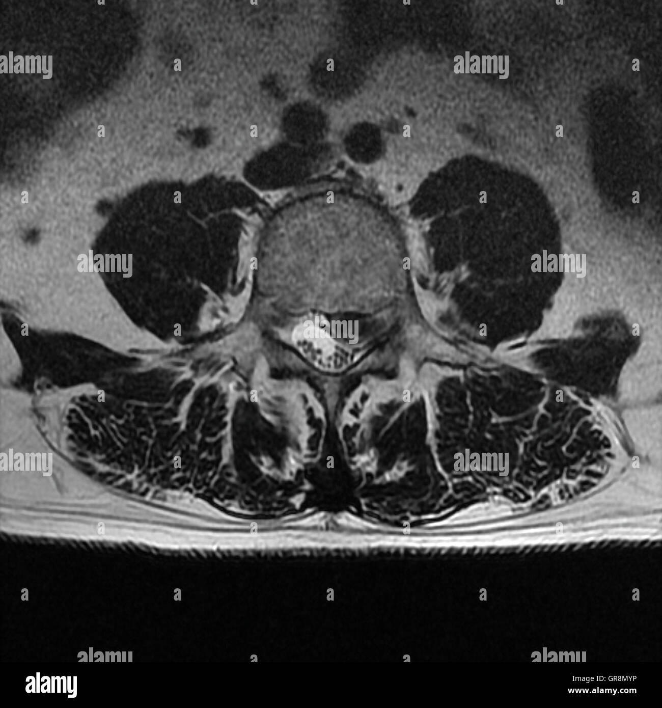 MRT von einer lumbalen Scheibe Herniation Stockfoto