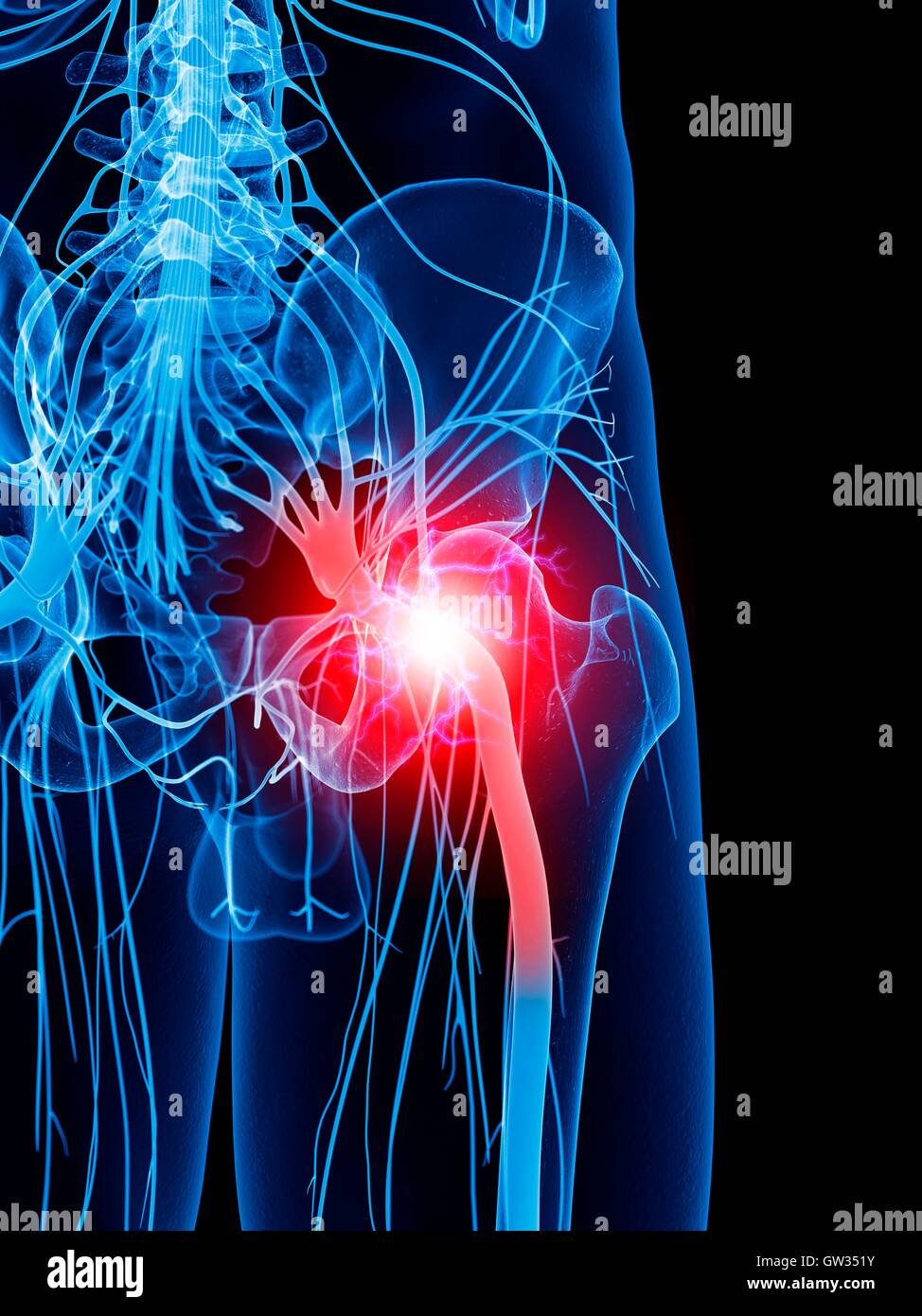 Menschlichen Ischiasnerv Schmerzen, Abbildung. Stockfoto