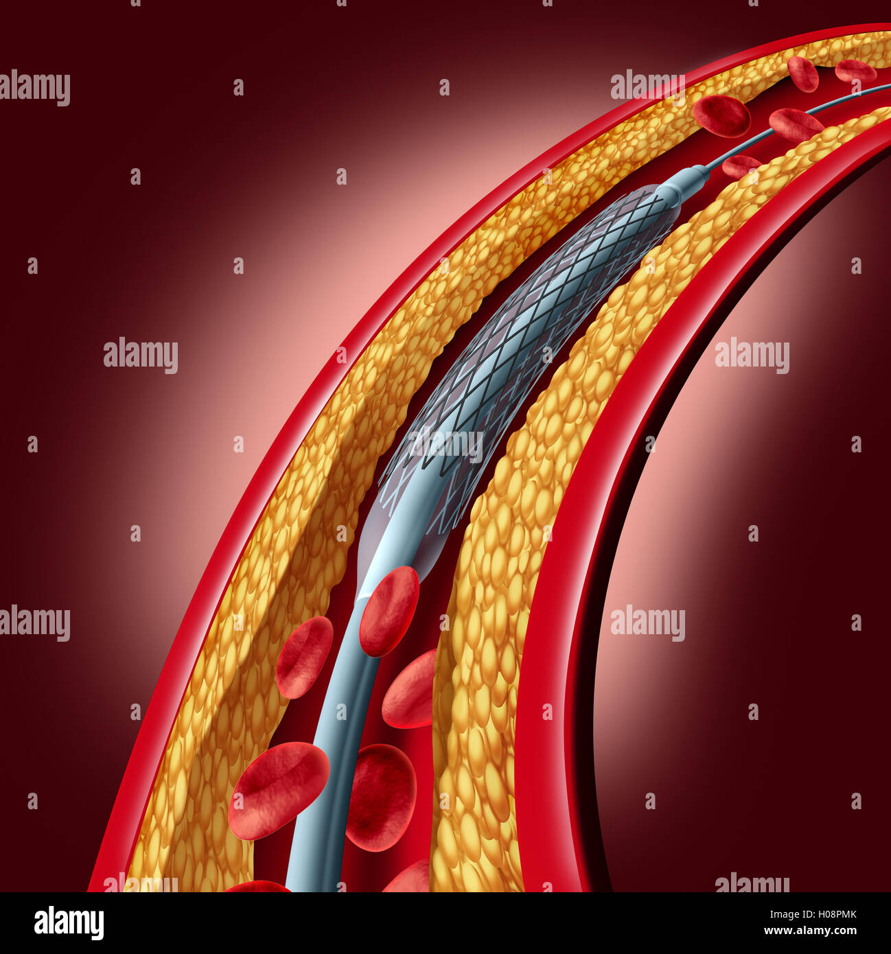 Stent koronare Platzierung als eine Angioplastie medizinisches Implantat Konzept als Herz-Kreislauferkrankungen Behandlung Symbol mit einem Implantat in einer Arterie, die Cholesterin Plaque Blockade als eine 3D Darstellung hat. Stockfoto