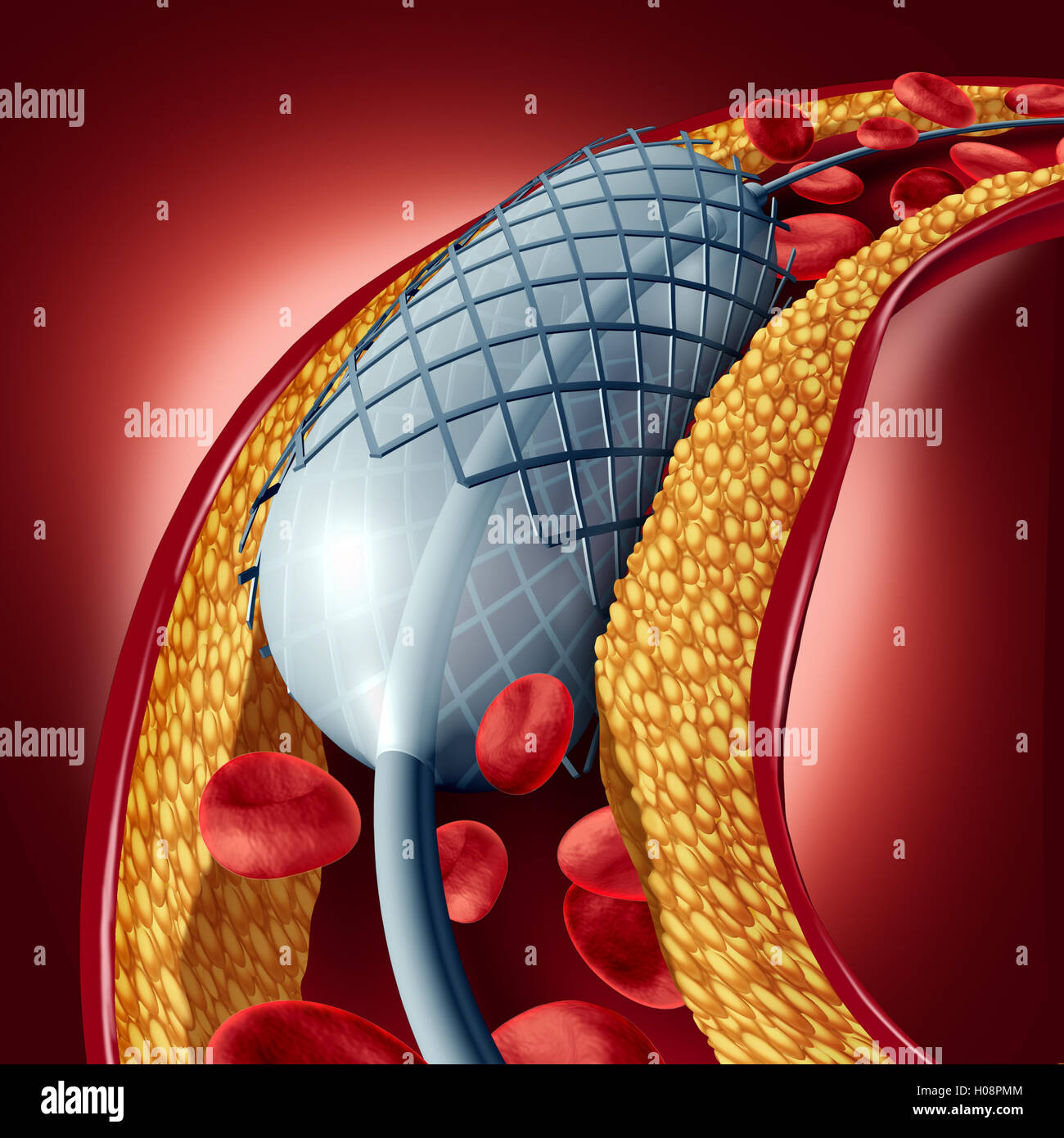 Angioplastie und Stent-Konzept als Herz-Kreislauferkrankungen Behandlung Symbol mit einem Implantat in einer Arterie, die Cholesterin Plaque Blockade für erhöhte Durchblutung als 3D Darstellung geöffnet hat. Stockfoto