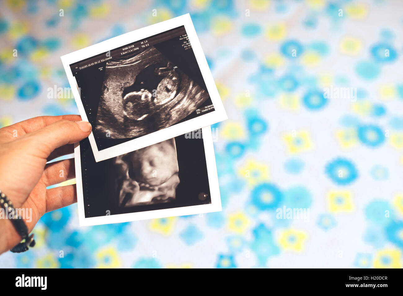 Frau die Hände halten zwei Baby Mädchen Ultraschall, 4D Ultraschall Stockfoto