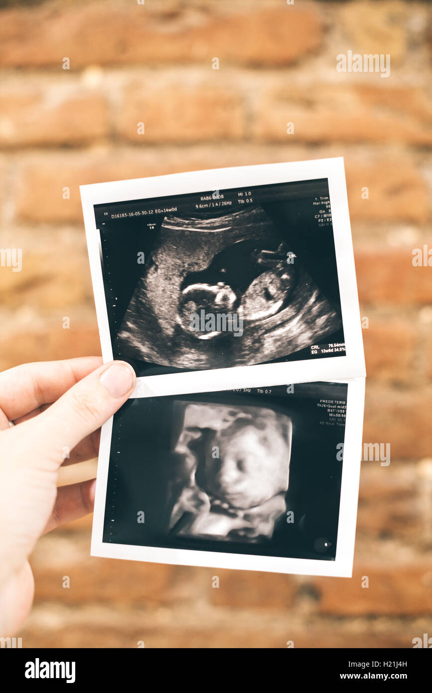 Frau die Hände halten zwei Baby Mädchen Ultraschall, 4D Ultraschall Stockfoto