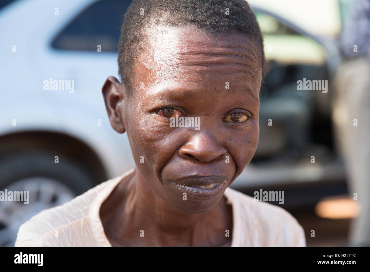 Ribaue Krankenhaus, Ribaue, Provinz Nampula, Mosambik, August 2015: Rosalina Alberto nach ihrer ersten Kataraktoperation hat Anblick auf ihrem rechten Auge wiederhergestellt. Foto: Mike Goldwater Stockfoto