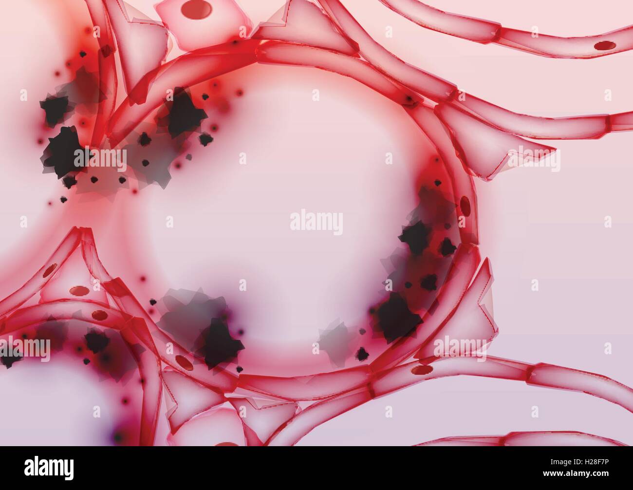 Entzündeten Alveolen in der Lunge Gewebe Slice, Querschnitt, Rauchen Tar Stock Vektor