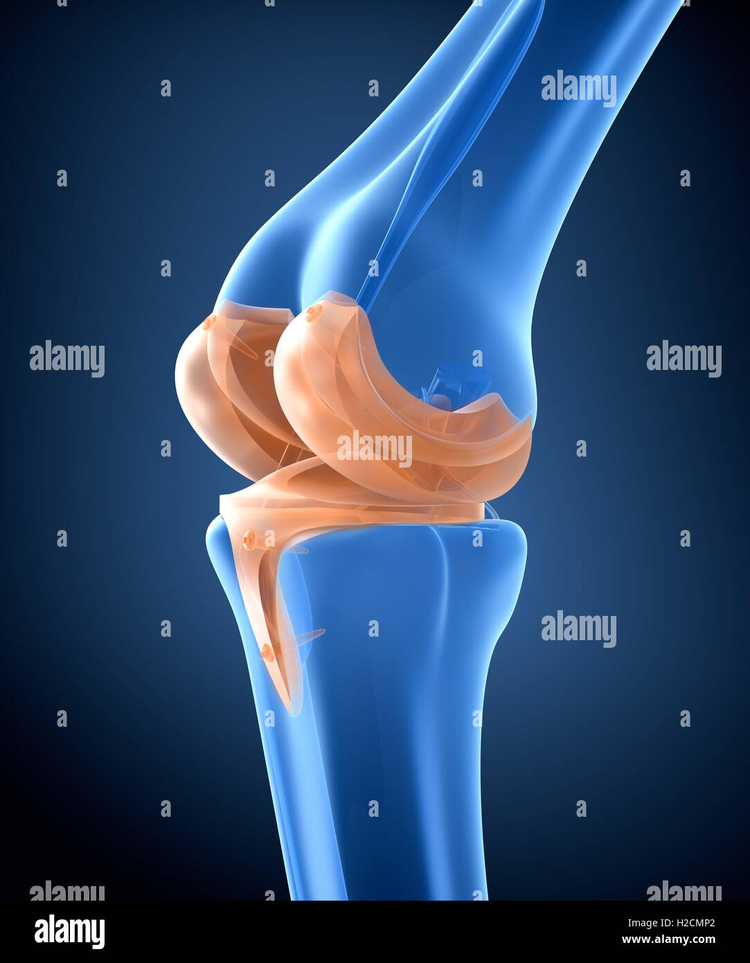Knie und Titan Scharniergelenk. Röntgenblick.  3D illustration Stockfoto