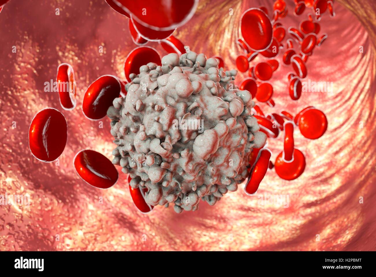 Computer Bild von roten Blutkörperchen und ein Krebs Leukämie weiße Blutkörperchen. Stockfoto