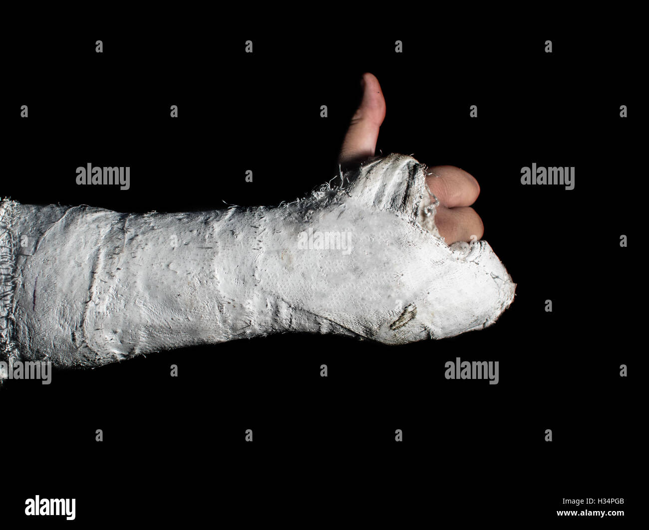 Gebrochenen arm in einer Form tun, einen Daumen nach oben Stockfoto