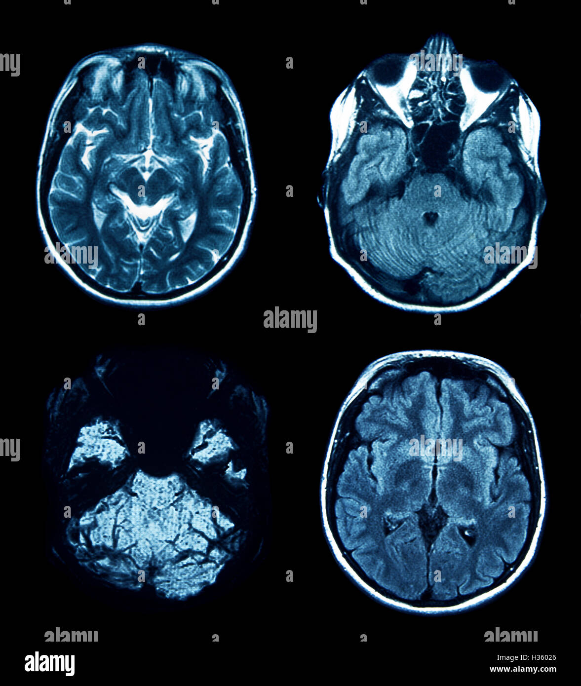 Satz von MRI-Scans auf schwarz Stockfoto