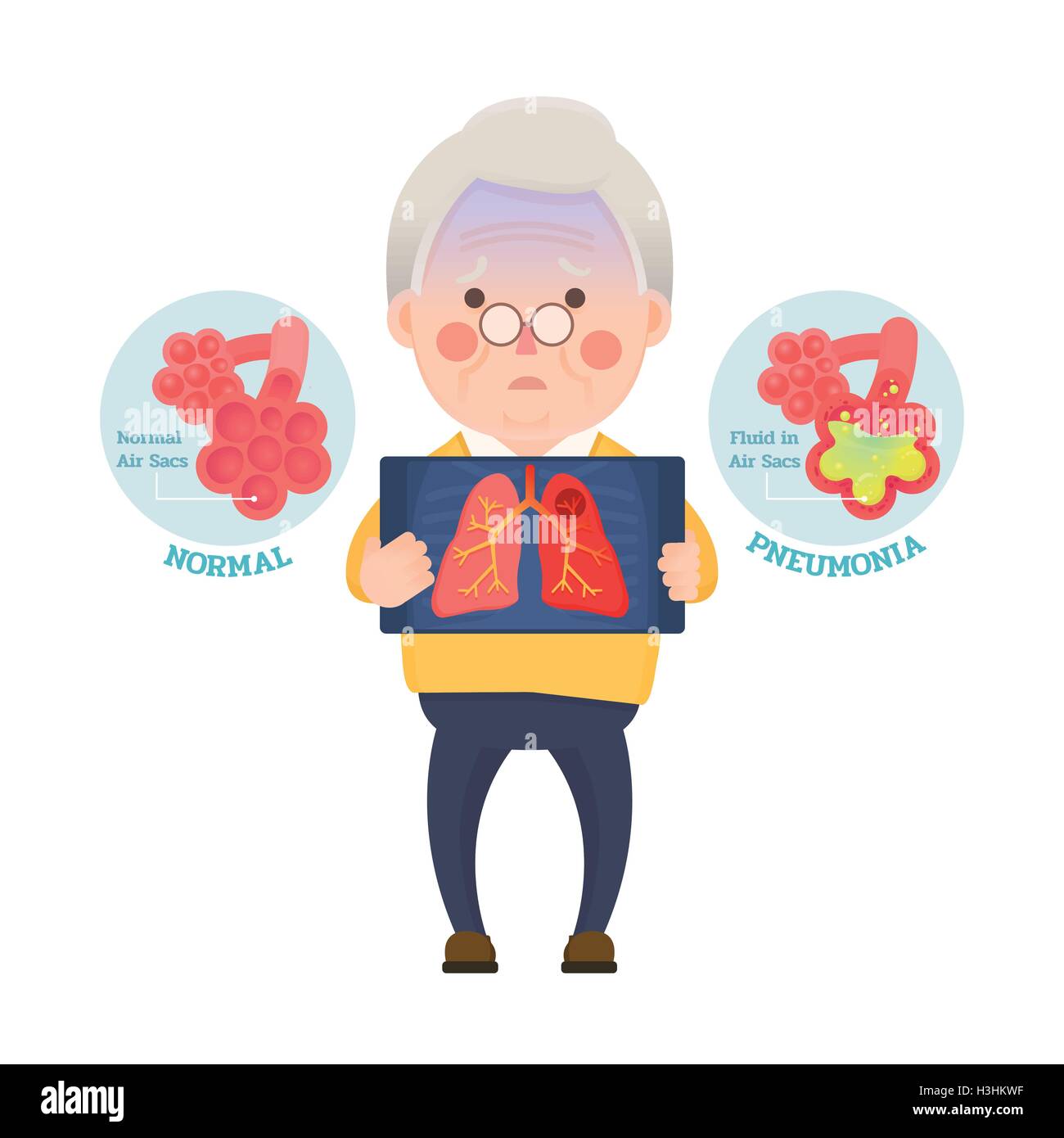 Vektor-Illustration der Alter Mann, hält Röntgenbild zeigt Lunge Lungenentzündung Problem, Comicfigur Stock Vektor