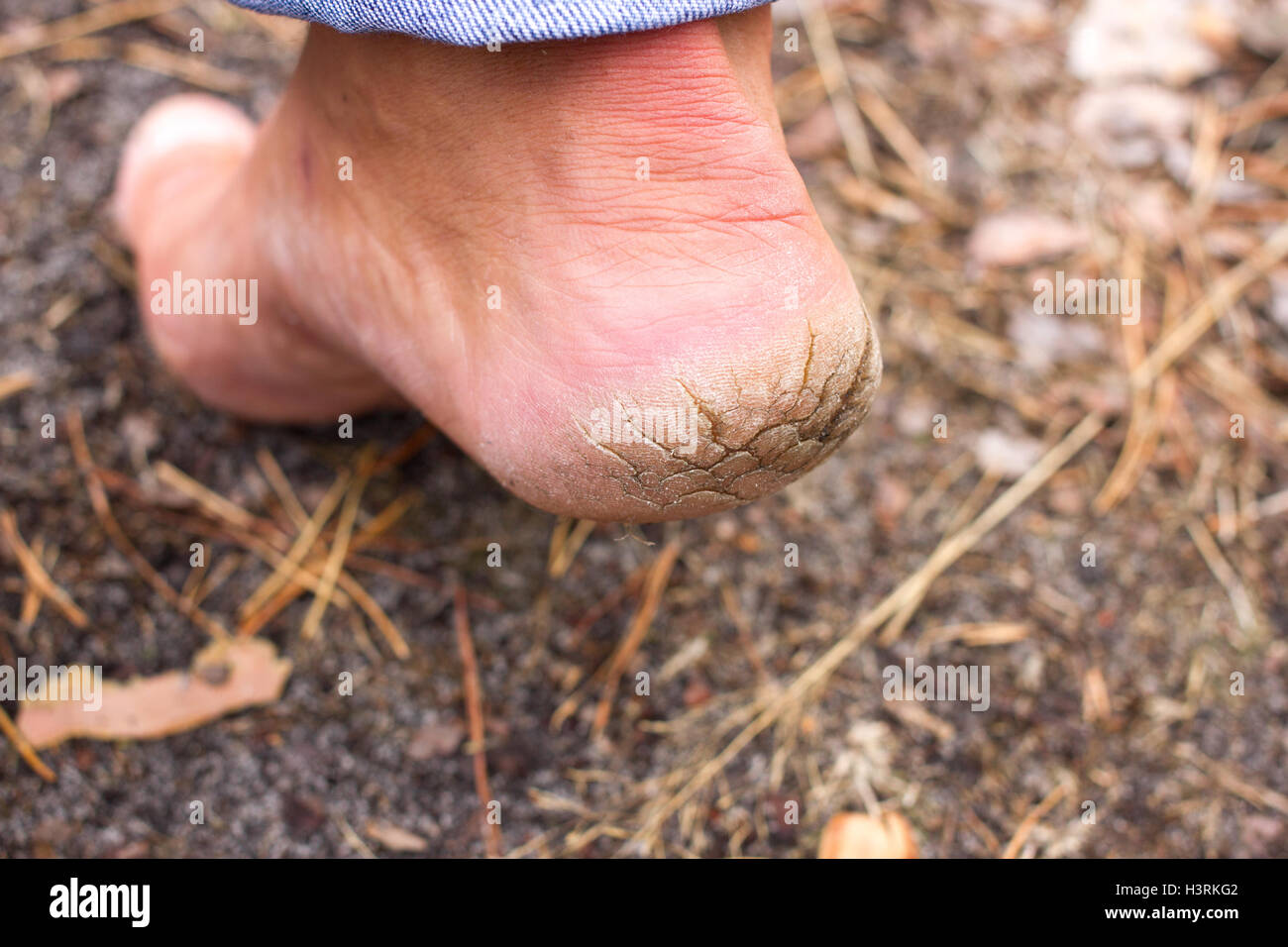 Nahaufnahme Foto Paar Rissige Fersen Mannliche Ruckansicht Stockfotografie Alamy