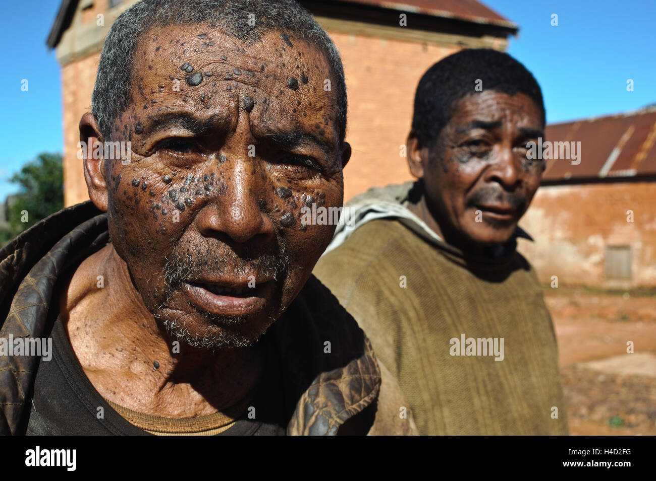Vater und Sohn mit dem gleichen Hautproblem (d.h. Dermatose Papulosa Nigra) (Madagaskar) Stockfoto