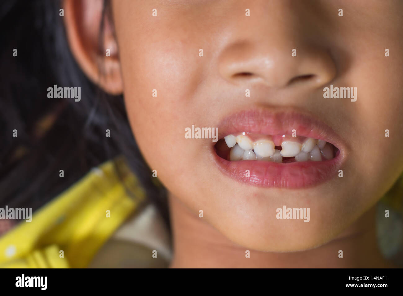 junge Patienten offenem Mund zeigt Hohlräume. Stockfoto