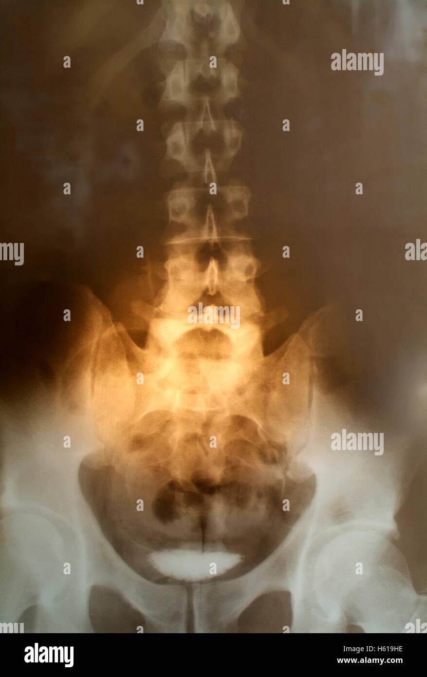 Röntgenaufnahme der Wirbelsäule Stockfoto