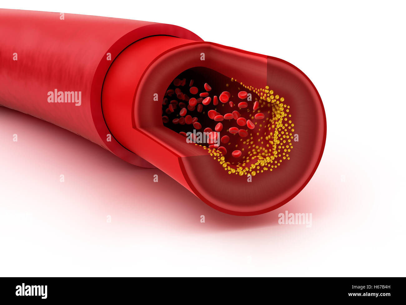 Plaque Cholesterin in Blutgefäßen, 3D illustration Stockfoto