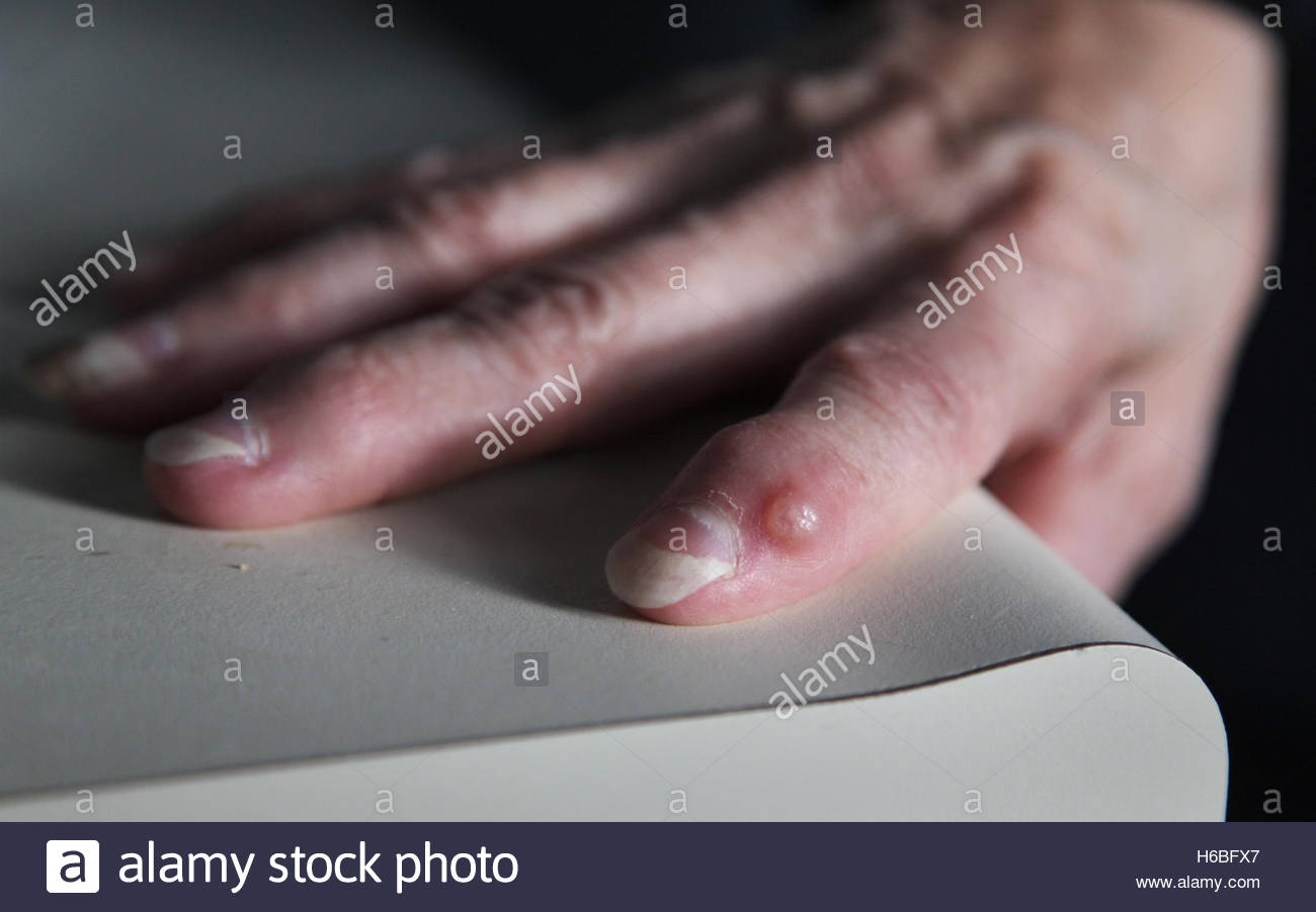 Cyst Stockfotos &amp; Cyst Bilder Alamy
