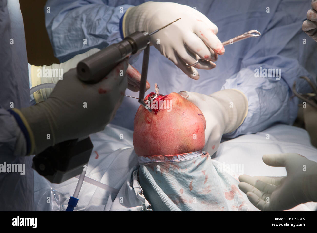 Externe Fixation der Radiuskopf Ellenbogen. Chirurgen ausführen eine Ellenbogen-operation Stockfoto