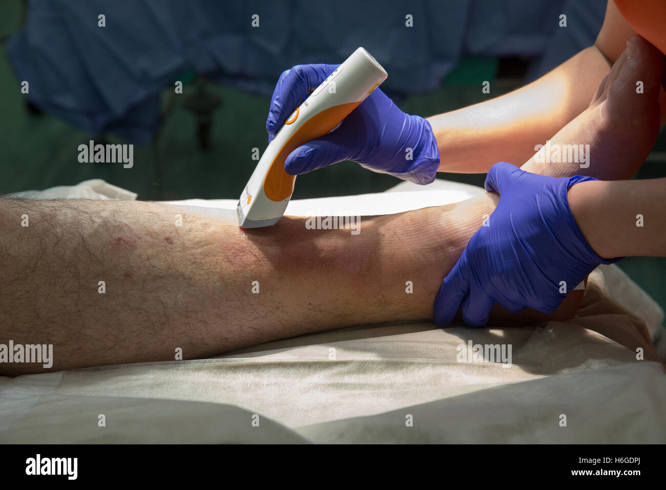 Vorbereitung des Patienten auf offenen Reposition und Osteosynthese Knöchel-Sprunggelenk-Operation. Das Bein des Patienten wird rasiert Stockfoto