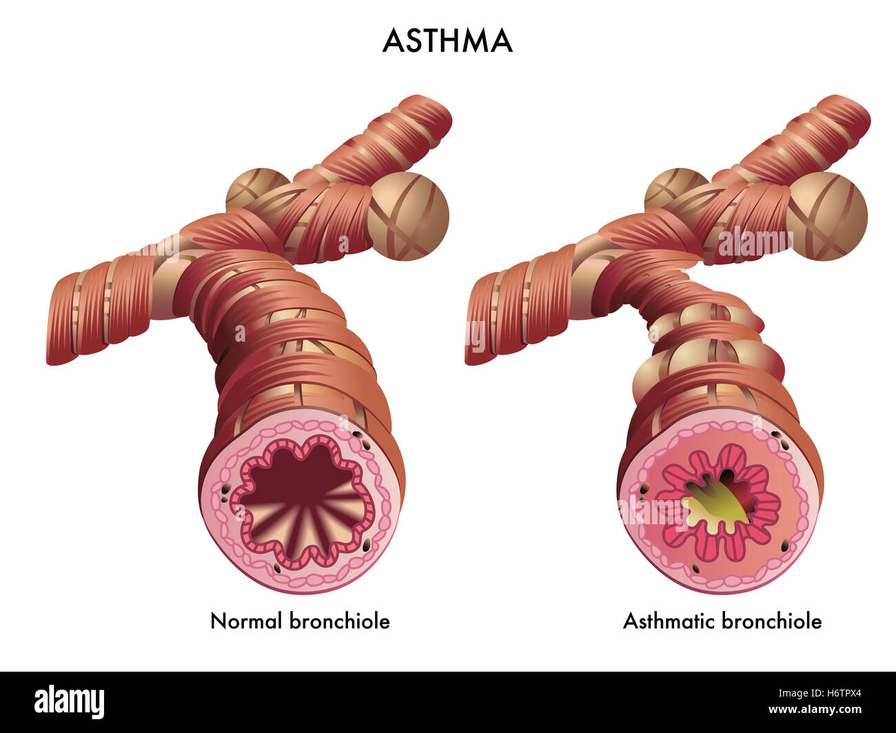 Asthma-Krankheit Asthma Infektion Atmung Krankheit Krankheit Inhalator Brust Bronchitis Bronchiolitis Asthma Bronchialasthma Stockfoto