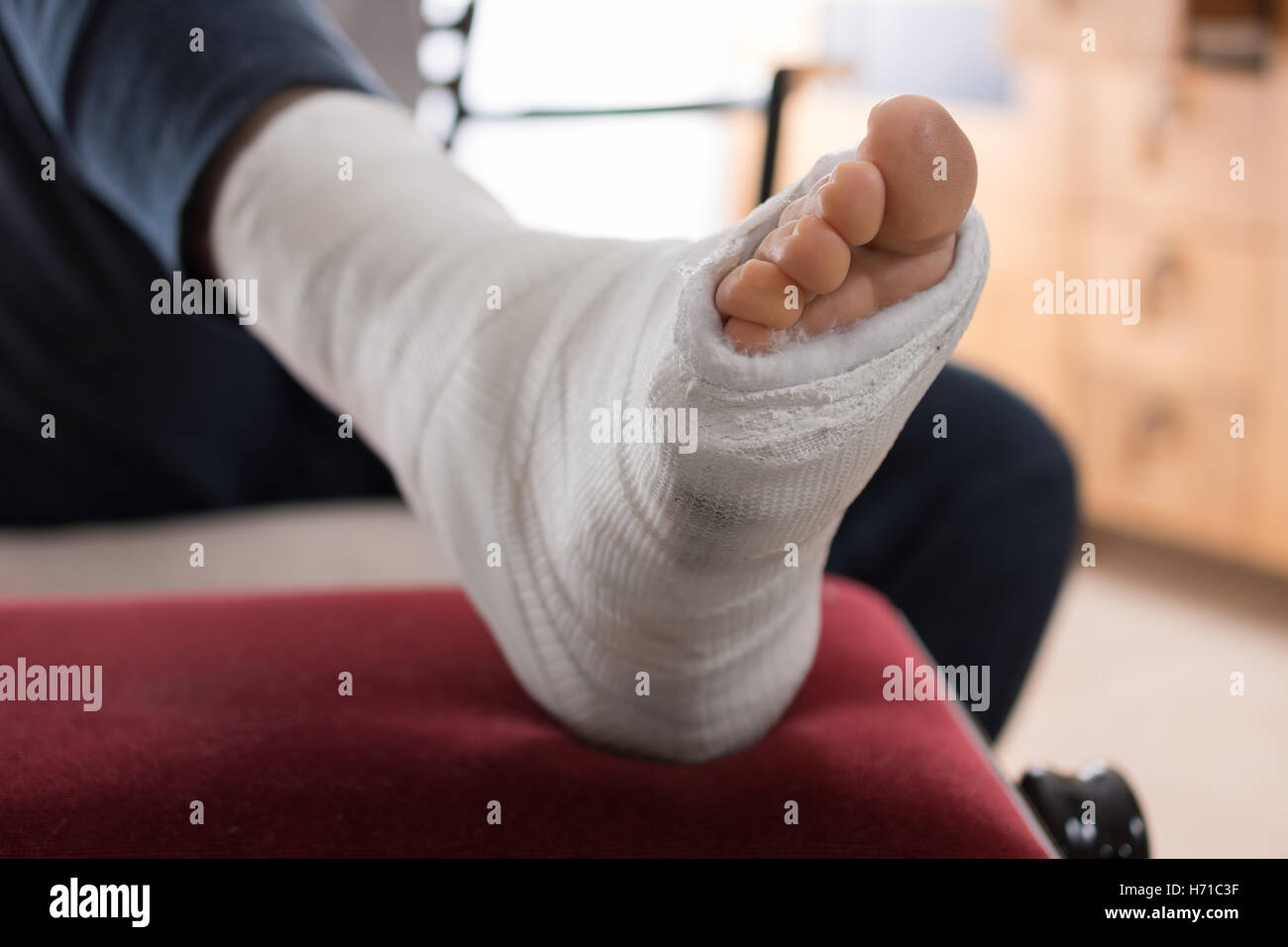 Nahaufnahme eines jungen Mannes Fiberglas / Gips Gipsbein und Zehen nach einer laufenden Verletzung Stockfoto