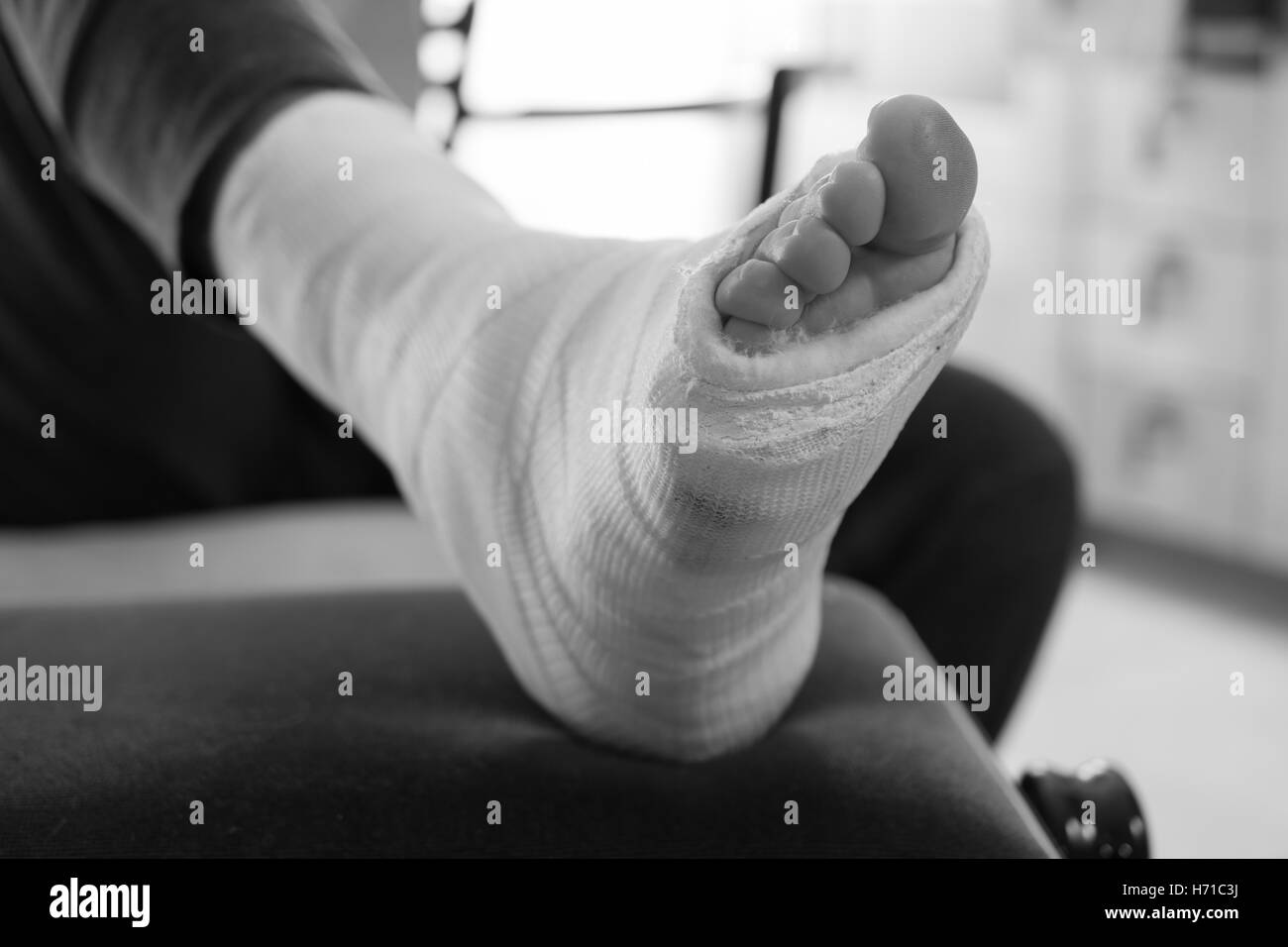 Nahaufnahme eines jungen Mannes Fiberglas / Gips Gipsbein und Zehen nach einer laufenden Verletzung (schwarz & weiß) Stockfoto