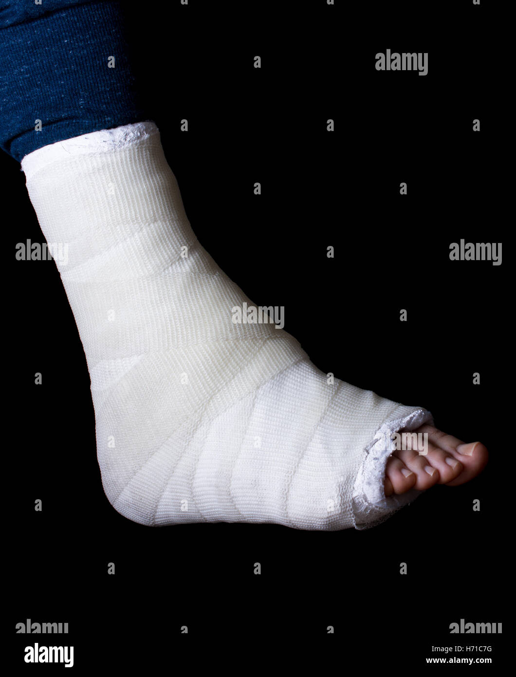 Weissputz und Fiberglas Bein Besetzung getragen von einem jungen Mann (isoliert auf schwarz) Stockfoto