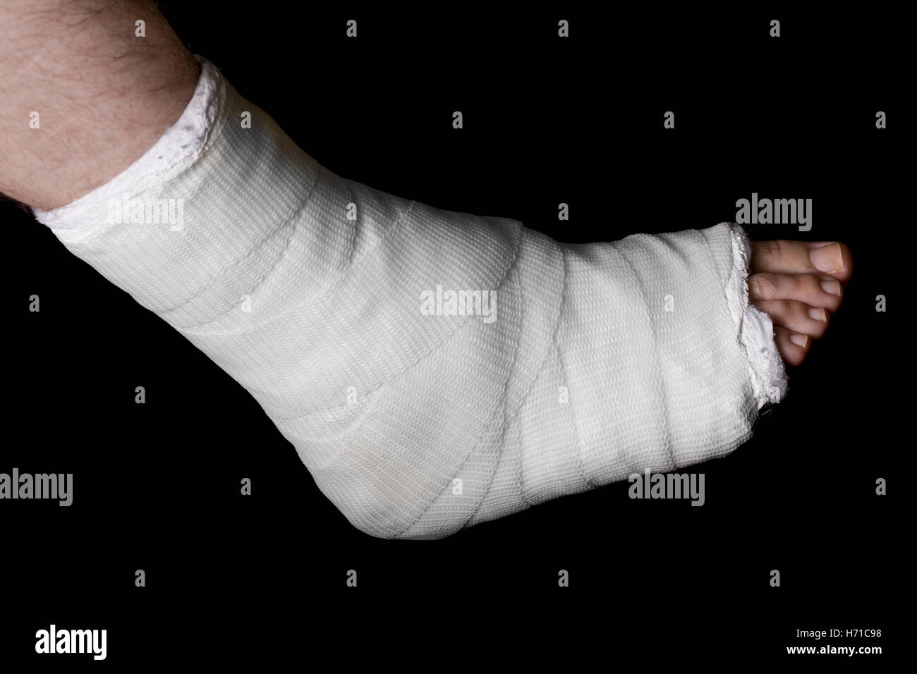 Weissputz und Fiberglas Bein Besetzung getragen von einem jungen Mann (isoliert auf schwarz) Stockfoto