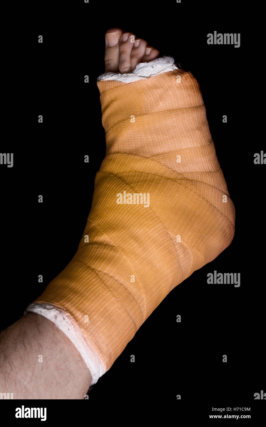 Orange Gips und Fiberglas Bein Besetzung getragen von einem jungen Mann (isoliert auf schwarz) Stockfoto