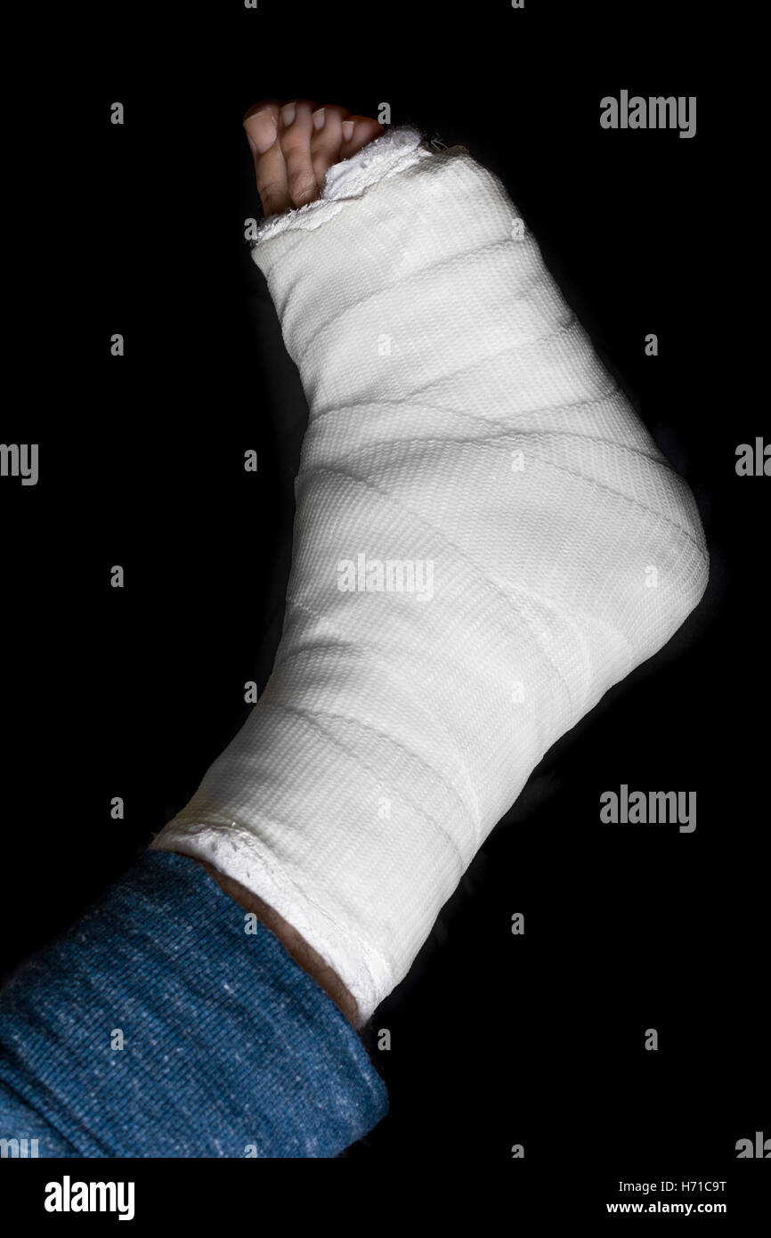 Weissputz und Fiberglas Bein Besetzung getragen von einem jungen Mann (isoliert auf schwarz) Stockfoto