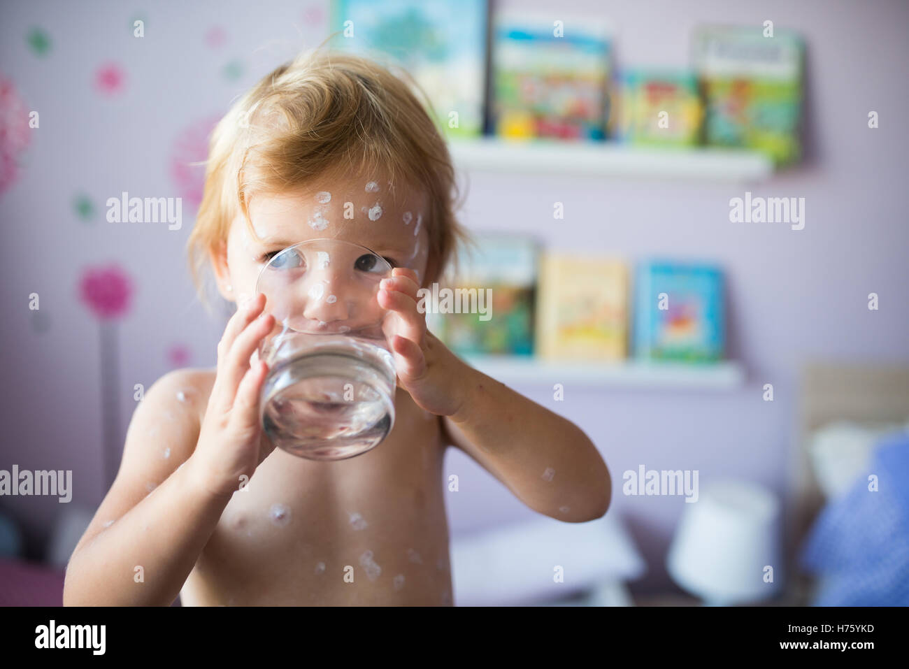 Kleines Mädchen mit Windpocken, Trinkwasser aus Glas Stockfoto