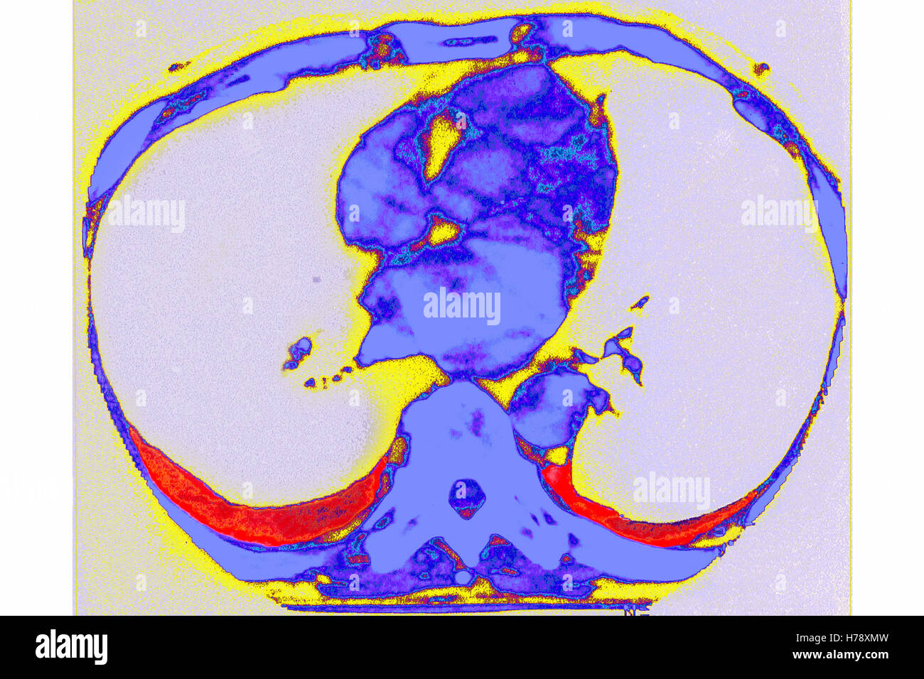 ASBESTOSE-SCANNER Stockfoto