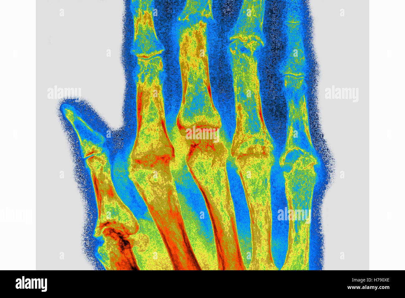 RHEUMATOIDE ARTHRITIS, X-RAY Stockfoto