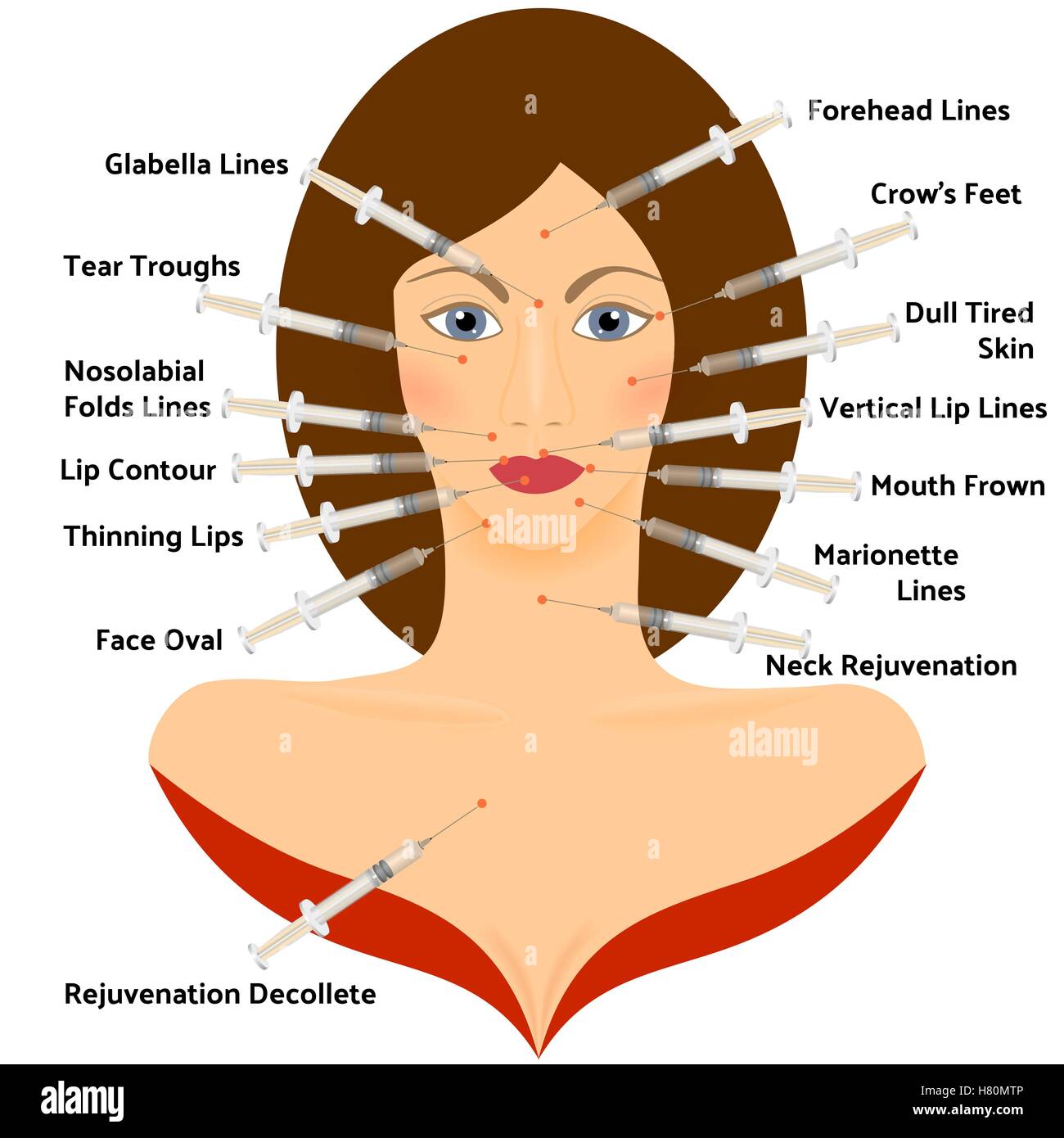 Hyaluronsäure Asid Infografik. Plastische Gesichtschirurgie Stock Vektor