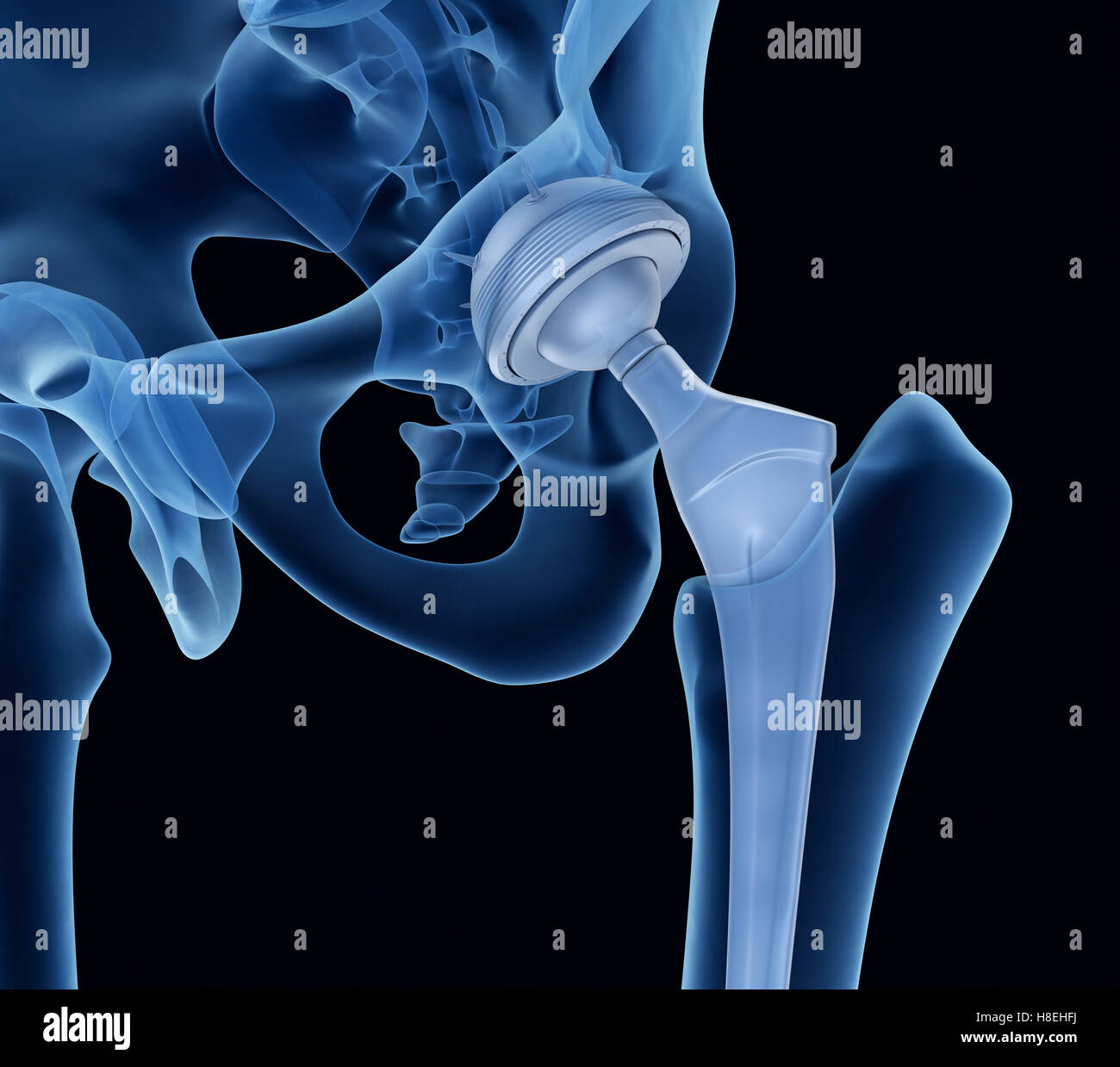 Hüftgelenkersatz-Implantat in den Knochen des Beckens installiert. Röntgenblick. Medizinisch genaue 3D-Illustration Stockfoto