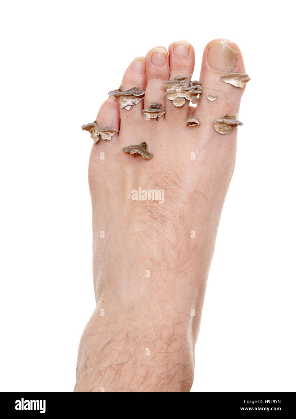 schmutzige infizierten Fuß Pilzerkrankungen auf weißem Hintergrund Stockfoto
