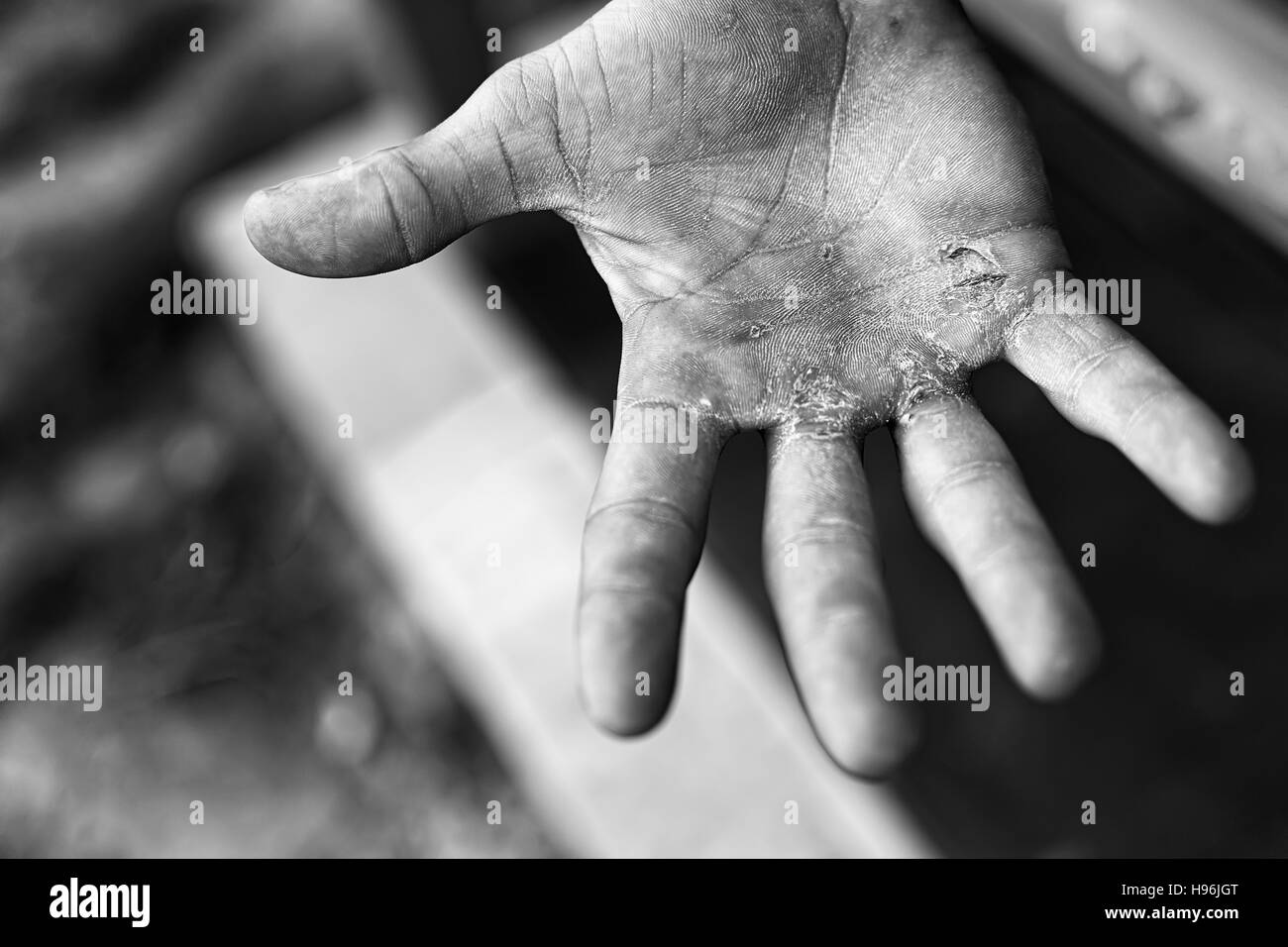 Palm mit Schwielen. Das Konzept der harten Arbeit. Bläschen auf der verletzten Seite aus Handarbeit. Stockfoto