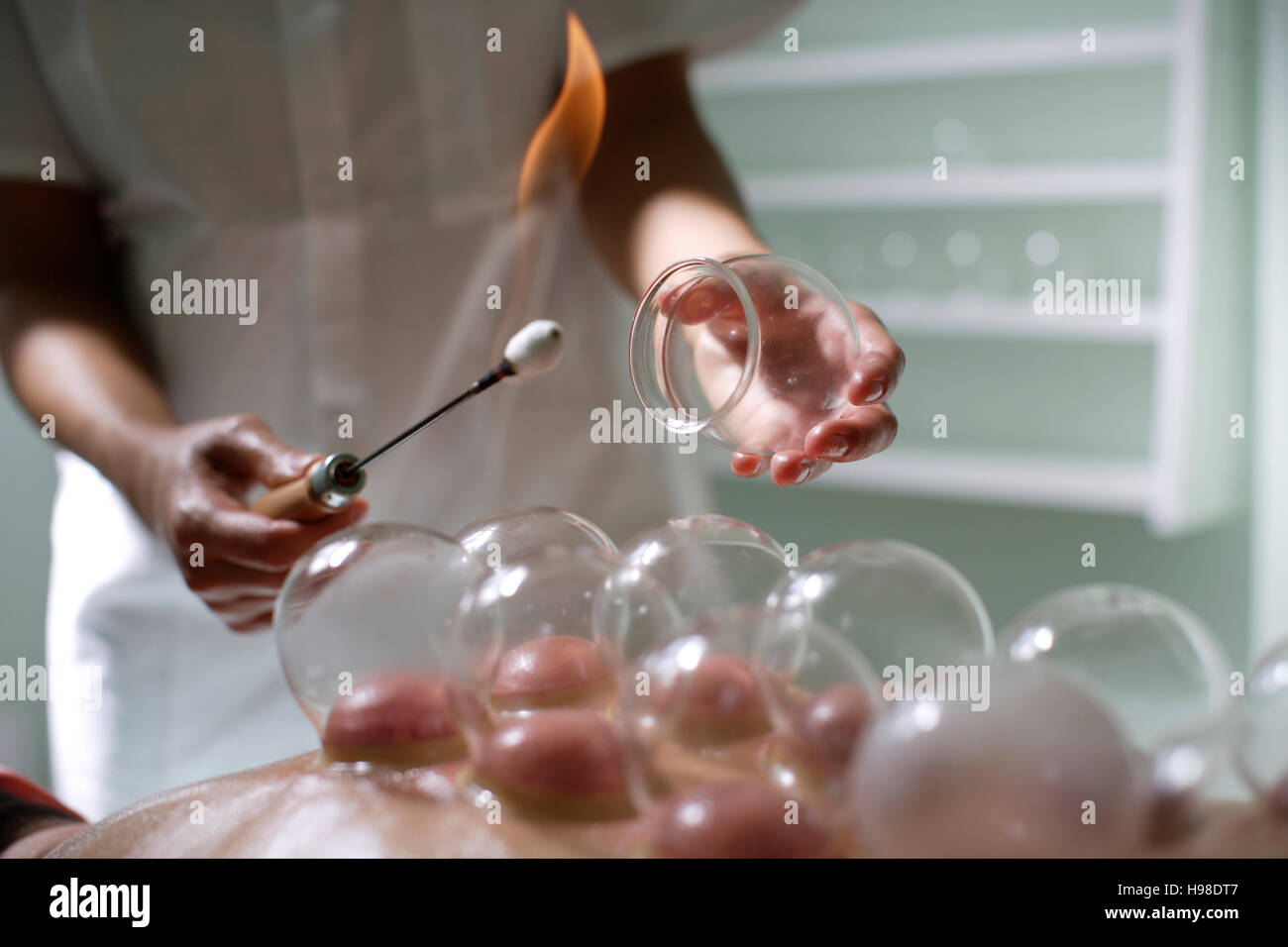 Feuer Schröpfen Therapie, Joachymsthal, westlichen Böhmen, Tschechische  Republik, Europa Stockfotografie - Alamy