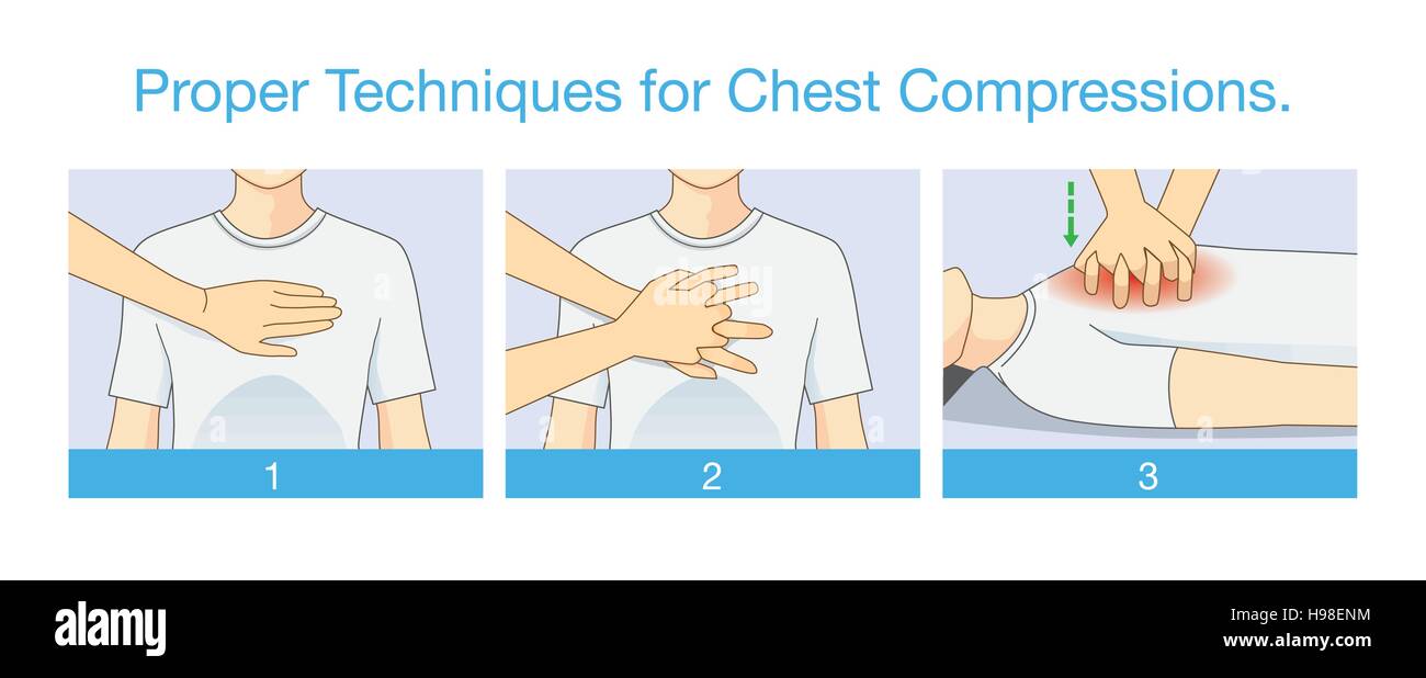 Richtigen Techniken für die Kompression der Brust. Stock Vektor