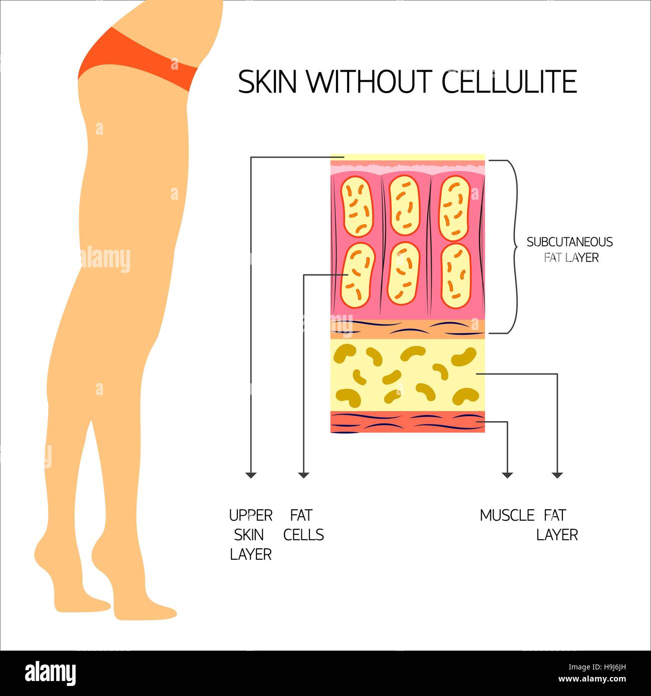 Cellulite-Vektor-illustration Stock Vektor