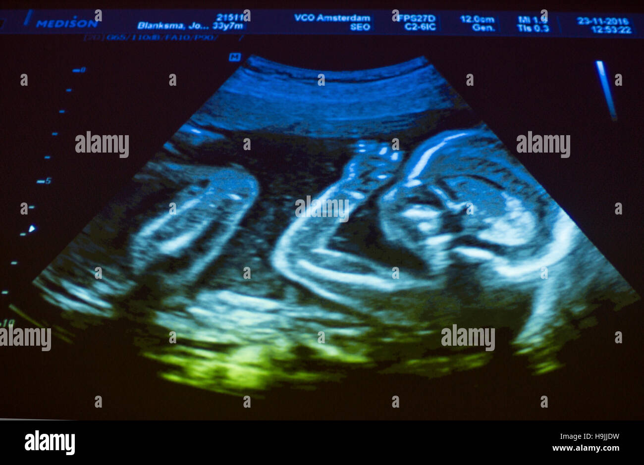 Ultraschalluntersuchung der schwangeren Frau 20 SSW Stockfoto, Bild