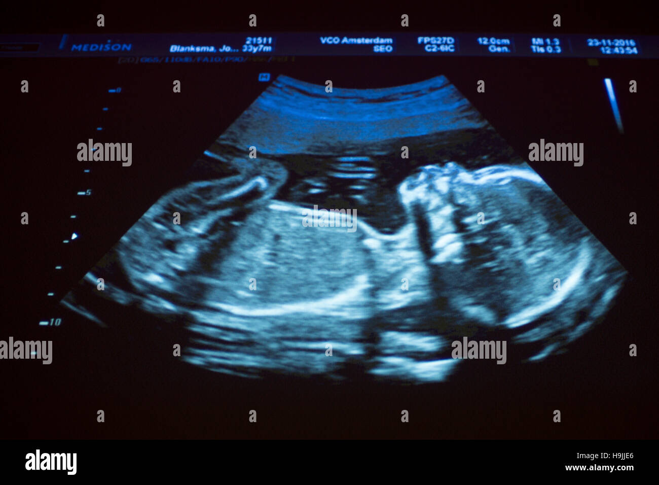 Ultraschalluntersuchung der schwangeren Frau 20 SSW Stockfoto, Bild