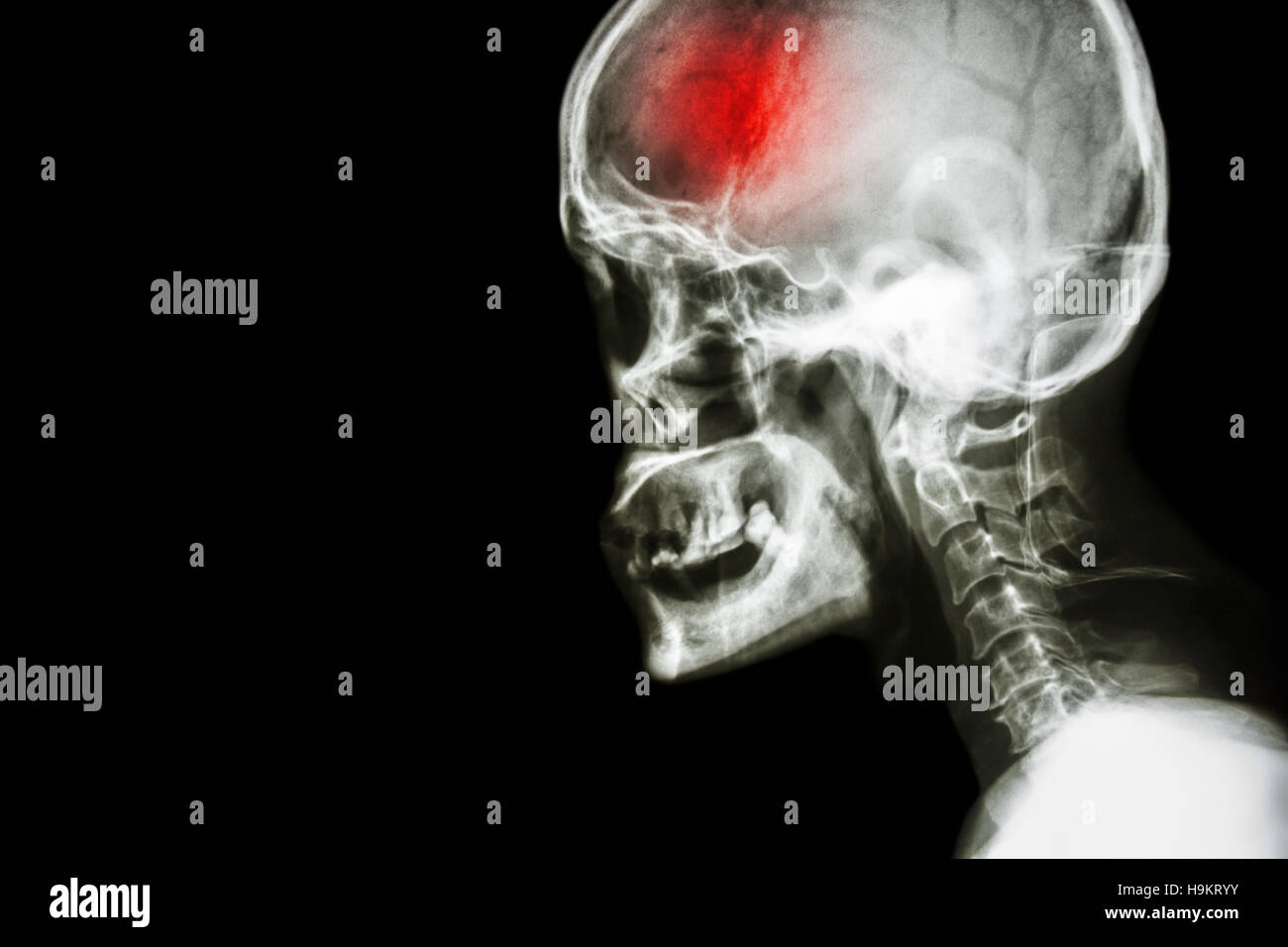 Schlaganfall. Film Röntgen Schädel und Halswirbelsäule Seitenansicht und Schlaganfall. Apoplexie. leeren Bereich auf der linken Seite. Stockfoto