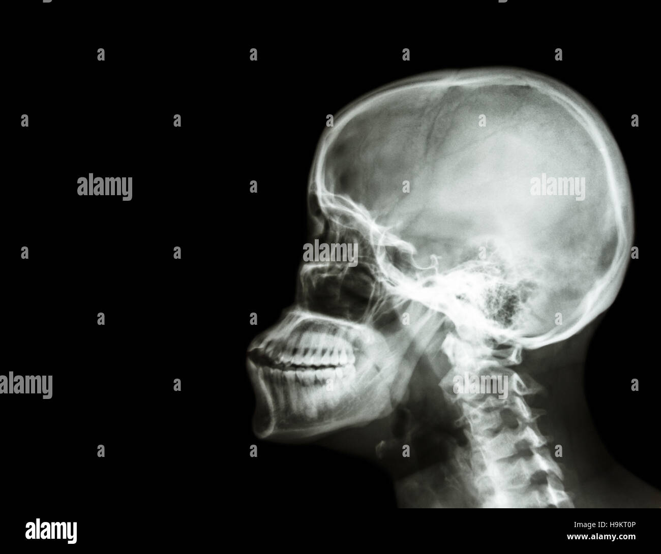 Film Röntgen Schädel und Halswirbelsäule Seitenansicht. leeren Bereich auf der linken Seite Stockfoto