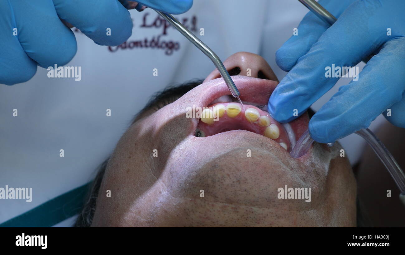 Zahnarzt und Patient Zahnreinigung Stockfoto